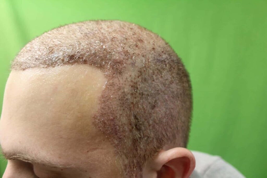 Patient's progress at the 1 week point during his hair transplant downtime. 