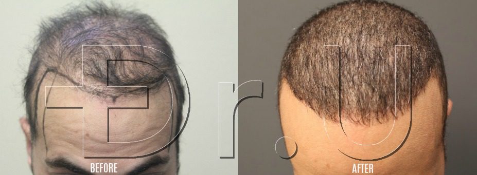 Before and after pictures of the top of the head.
