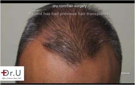 The Beverly Hills patient’s thinning hairline before Dr.UGraft FUE Corrective hair surgery in Los Angeles