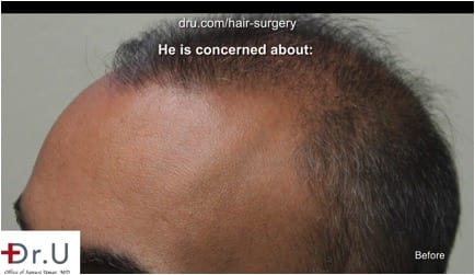  Weak and thinning temple points prior to hair transplant correction using DrUGraft