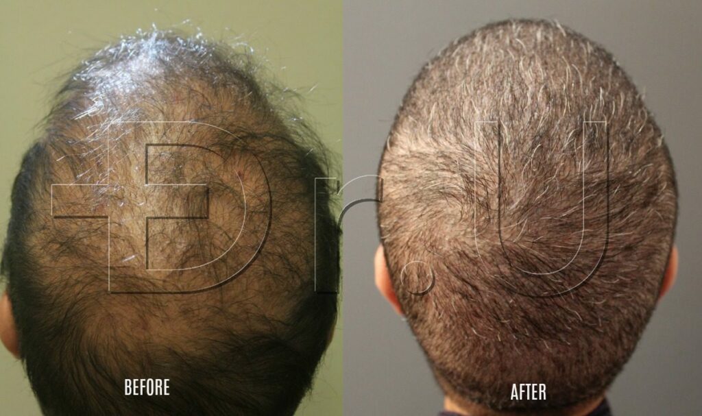Taking hair from the arms and other parts of the body.