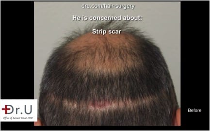 Beverly Hill's patient with visible scarring caused by surgery performed by another clinic .