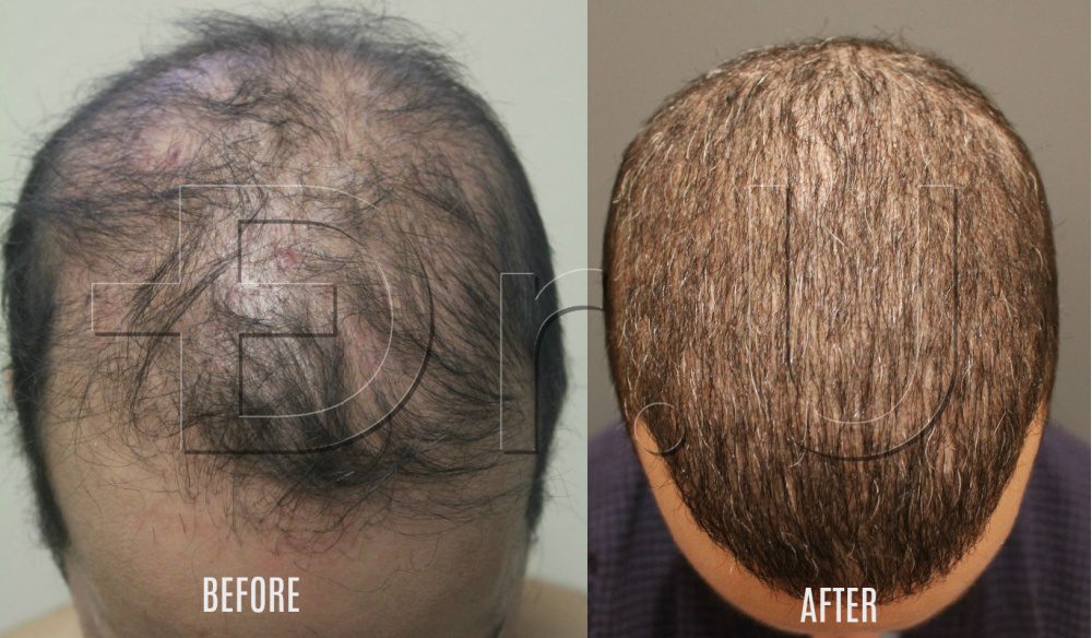 botched hair transplant repaired with head and body hair