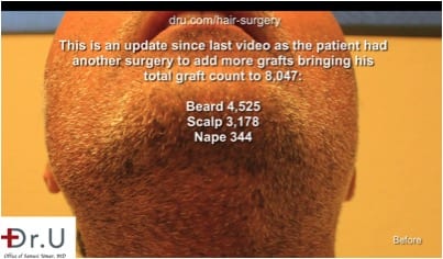  Primary donor area for the Dr.UGraft corrective hair surgery