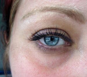 Reducing Puffiness and Under Eye Bags
