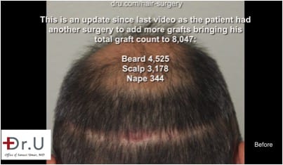  Highly visible linear wound required a repair surgery to cover this strip scar