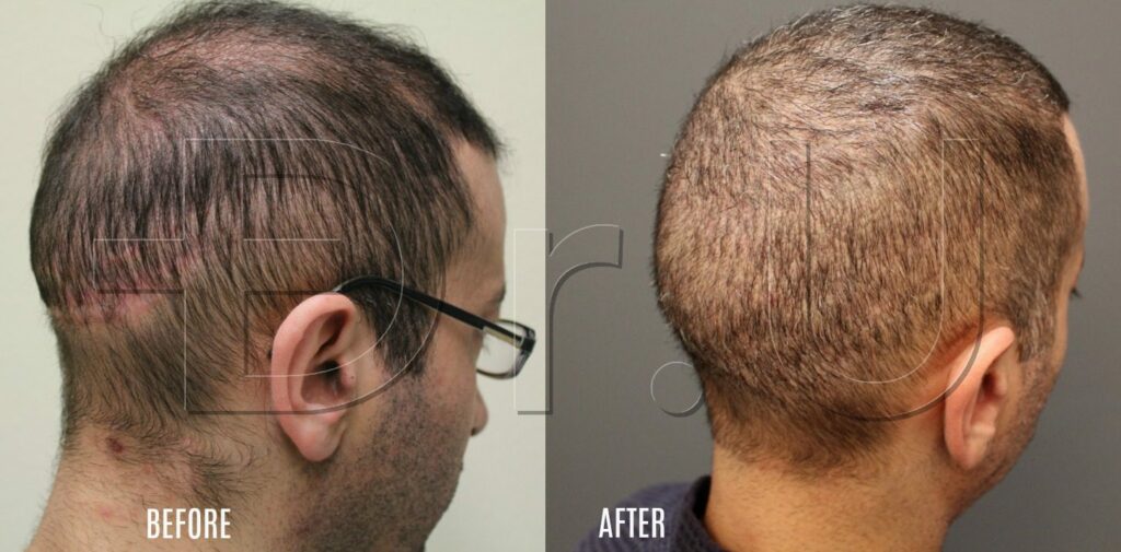 Facing right view of before and after pictures