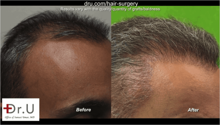  Stronger and fuller temple points after the Dr.UGraft repair to fix unsuccessful hair transplant from strip surgery