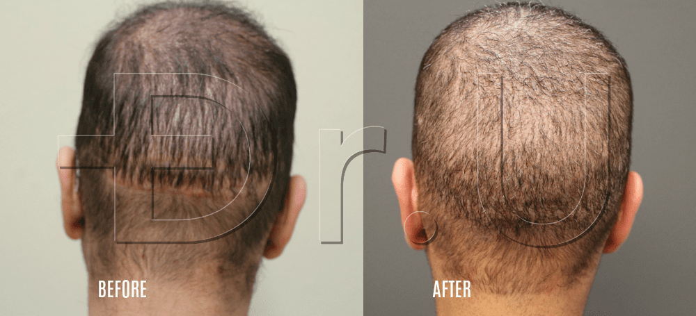 Rear view of wide strip scar repaired with head and non-head hair