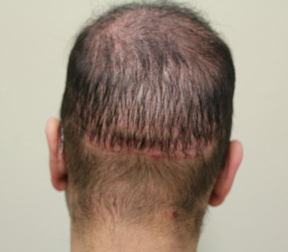 The double scar from a botched hair transplant surgery.