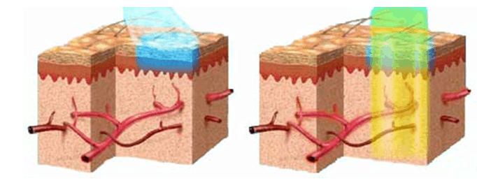 Pulses Dye laser emits laser yellow light having gone through a dye to target red pigments inside of the red blood cells (RBC) in the vessels