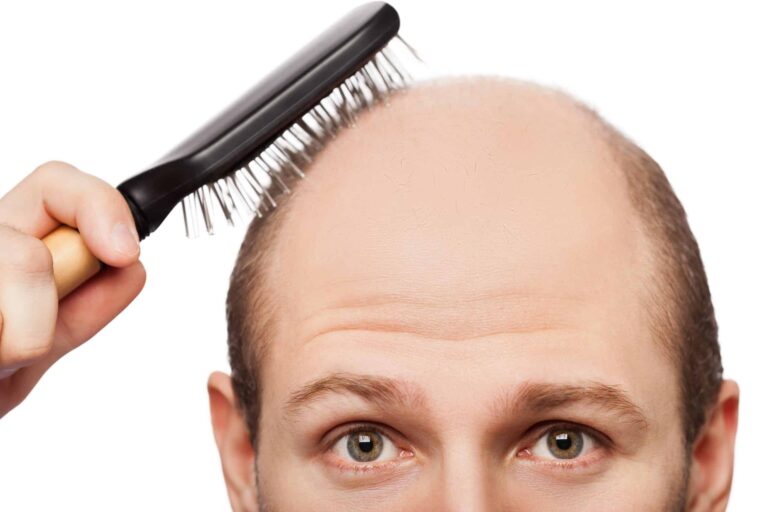 Change your identity by undergoing a full hair restoration.