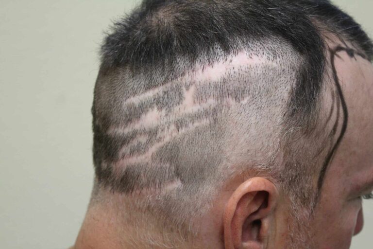 Strip Hair Transplant, FUSS patient with multiple linear scars