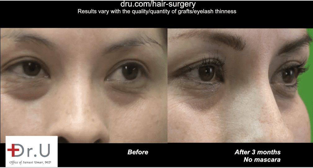 Dr.UGraft™’s unique design now makes it possible to use FUE grafts for eyelash transplants.*