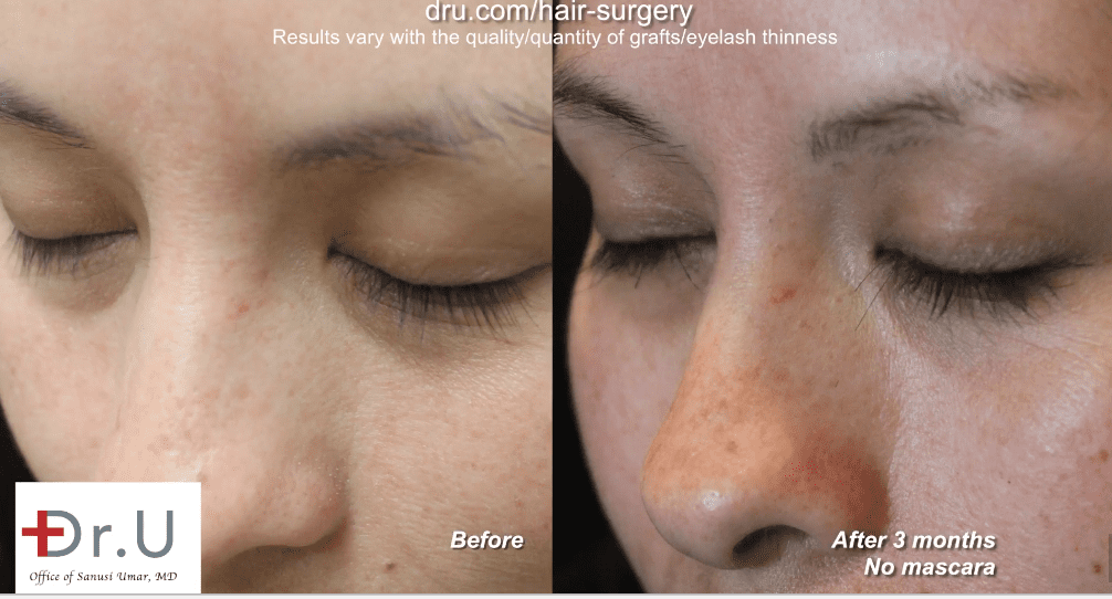 Three months after her Dr.UGraft eyelash extension surgery in Los Angeles, the patient shows excellent growth of her nape hair grafts
