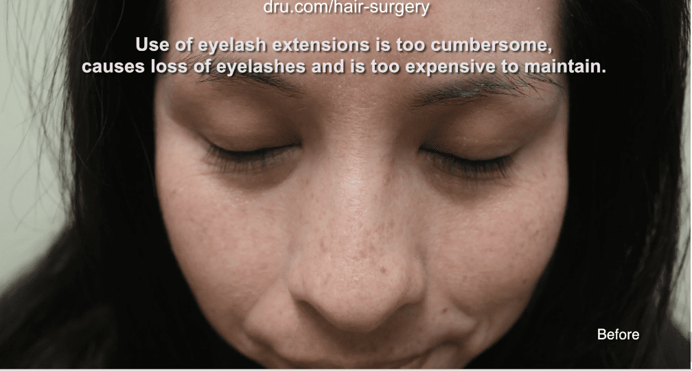 This patient had thin and sparse eyelashes before Dr.UGraft’s eyelash extension surgery.