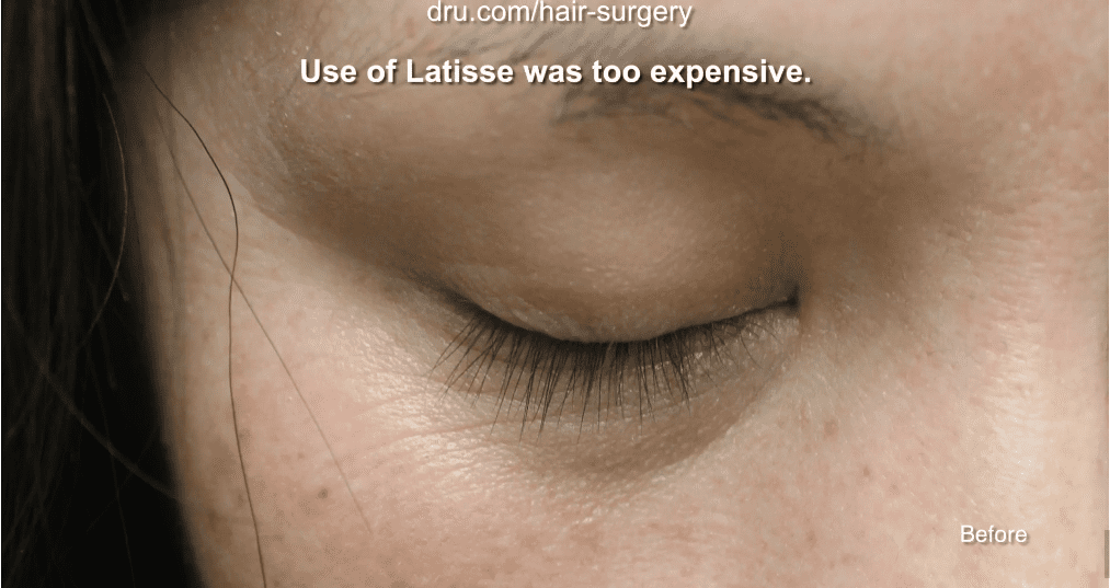 The patient was having difficulty thickening her eyelashes before undergoing Dr.UGraft's eyelash implant surgery.