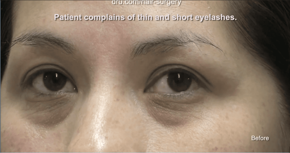 This patient had thin and sparse eyelashes before Dr.UGraft’s eyelash extension surgery
