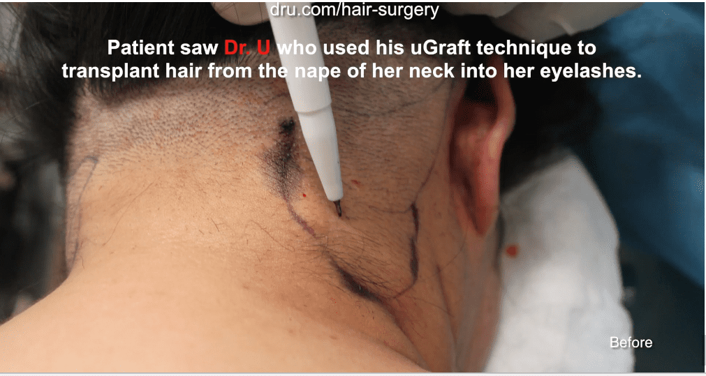 Dr.UGraft Eyelash Extensions surgery is how to get thicker eyelashes