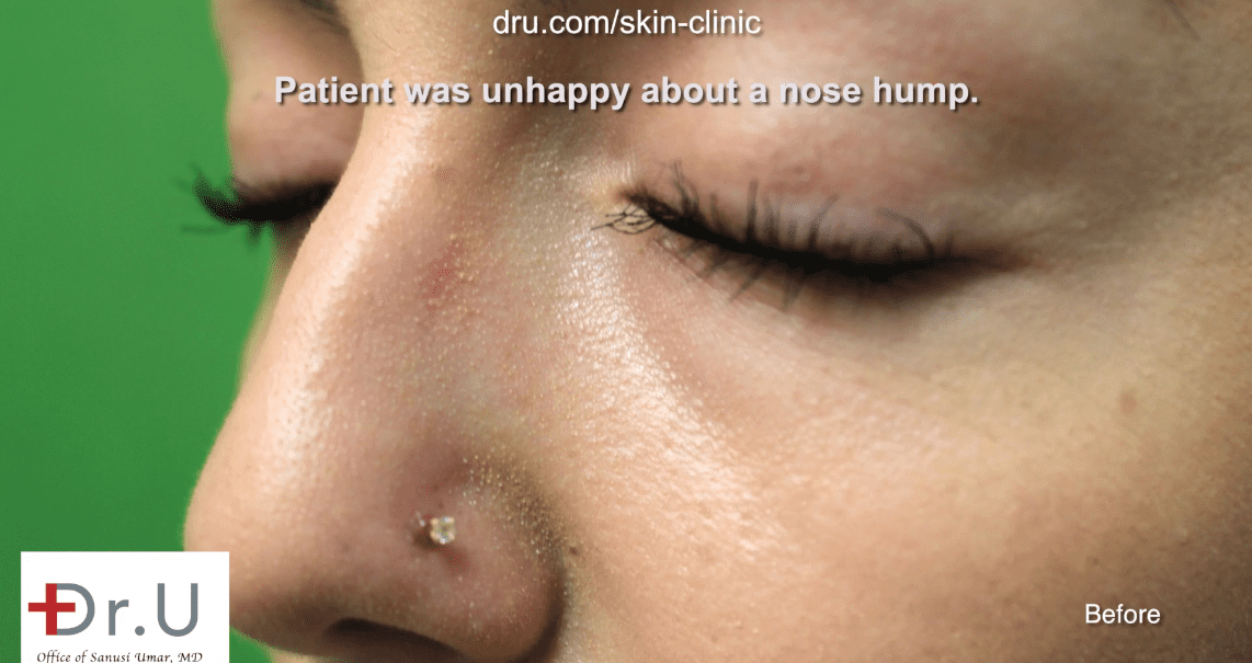 The patient before nose bump removal without surgery.