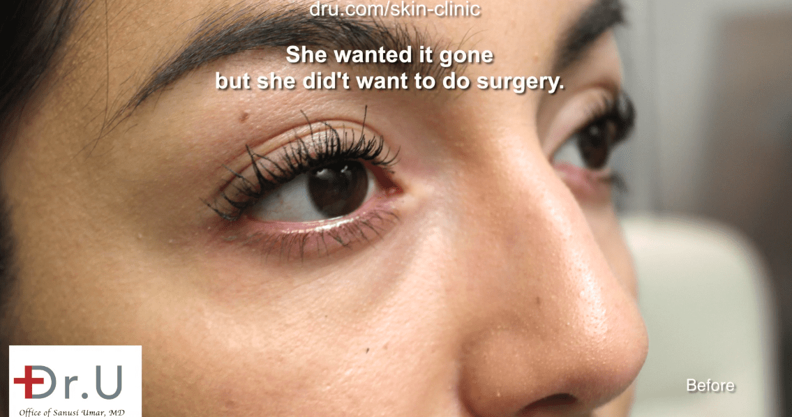 Beverly Hills patient went to see Dr. U about bump on the nose removal.