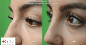 The patient after Radiesse was used as a nose filler for bump.*