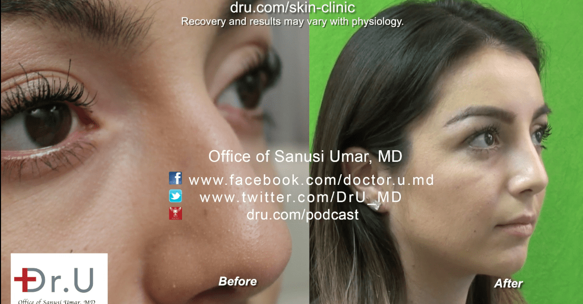 The Beverly Hills patient was very pleased that she was able to get a rhinoplasty with no surgery.*
