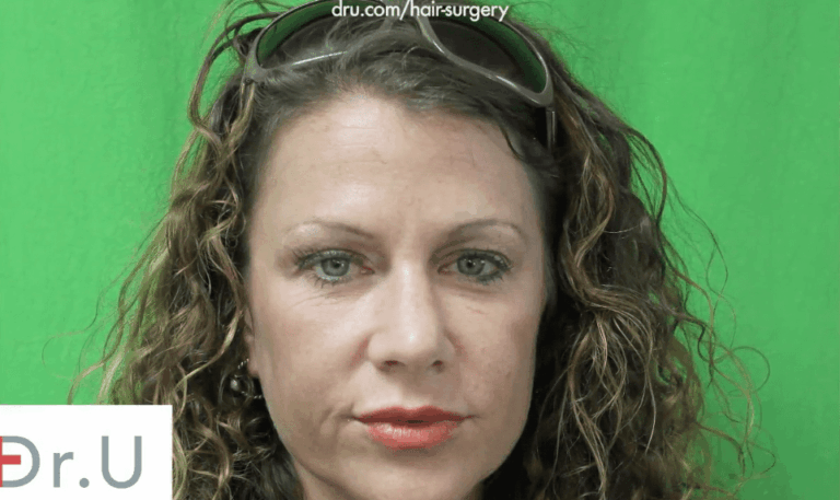 The patient hopes to correct the look of her thin, over-plucked eyebrows.