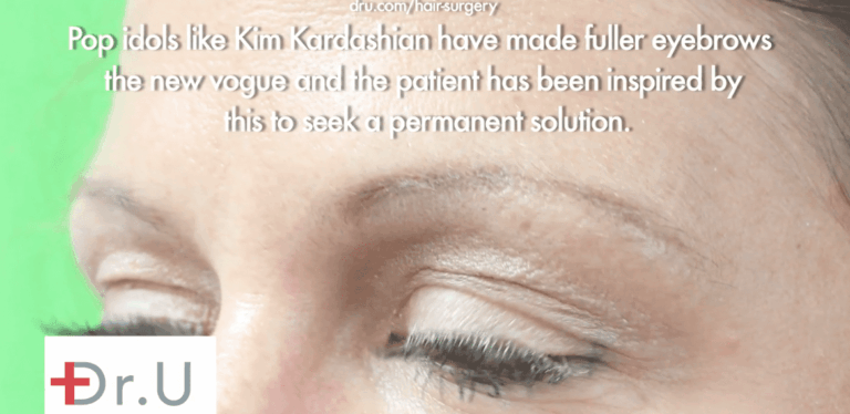 Manhattan Beach patient before her eyebrow hair restoration surgery