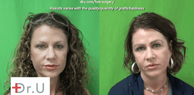 Manhattan Beach patient before and after her eyebrow transplant which achieved the thick shaped eyebrows that she hoped for