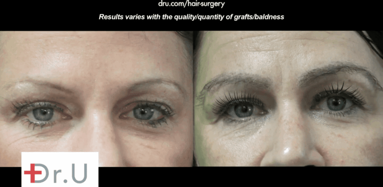 Before and after eyebrow restoration surgery with nape hair showing the thick shaped eyebrows inspired by Kim Kardashian