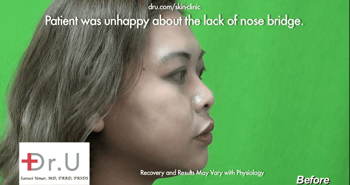 Low Asian nose bridge before her non-surgical nose job.* Low Asian nose bridge before her non-surgical nose job.*