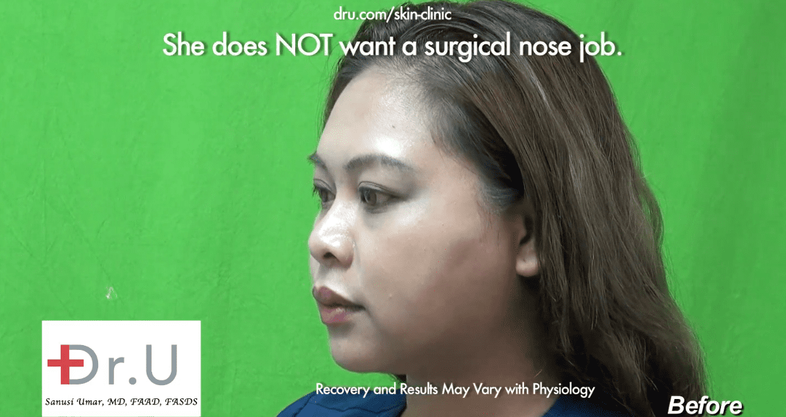 The patient was unhappy with her low nose bridge which caused her eyeglasses to constantly slide down her nose.* The patient was unhappy with her low nose bridge which caused her eyeglasses to constantly slide down her nose.*
