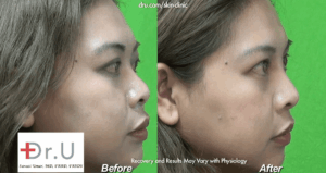 Before and After Nose Job Without Plastic Surgery