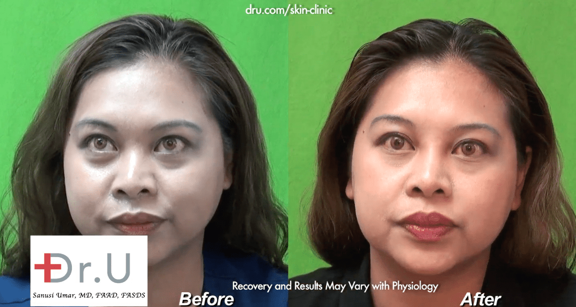 Rancho Palos Verdes patient noticed a subtle by significant improvement as a result of her Radiesse injection nose job by Dr. U.* The patient was very pleased with her Radiesse injection nose job by Dr. U.*