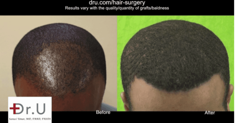 Black celebrity hair loss solution with Dr.UPunch Curl