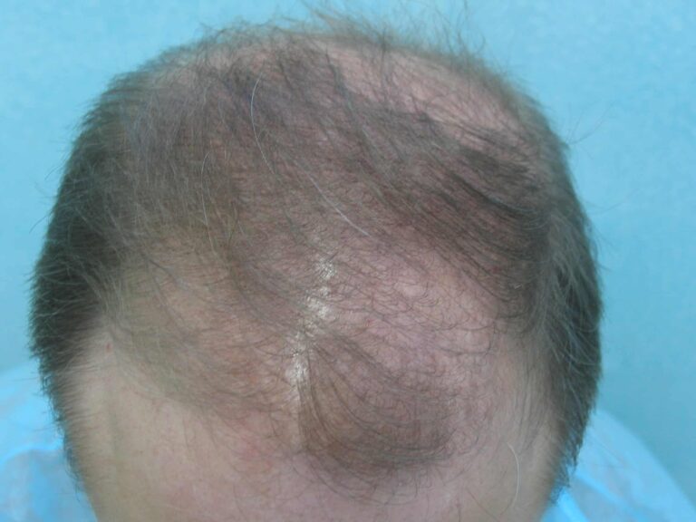 Top view of Norwood 6 FUE hair transplant patient's head