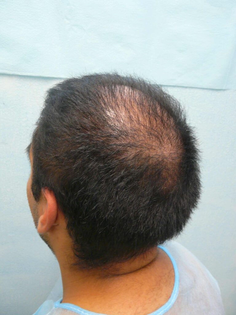 anatomic deformity from strip surgery causing crown to expand