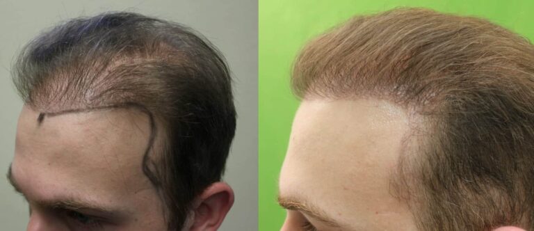 before and after hair transplant process