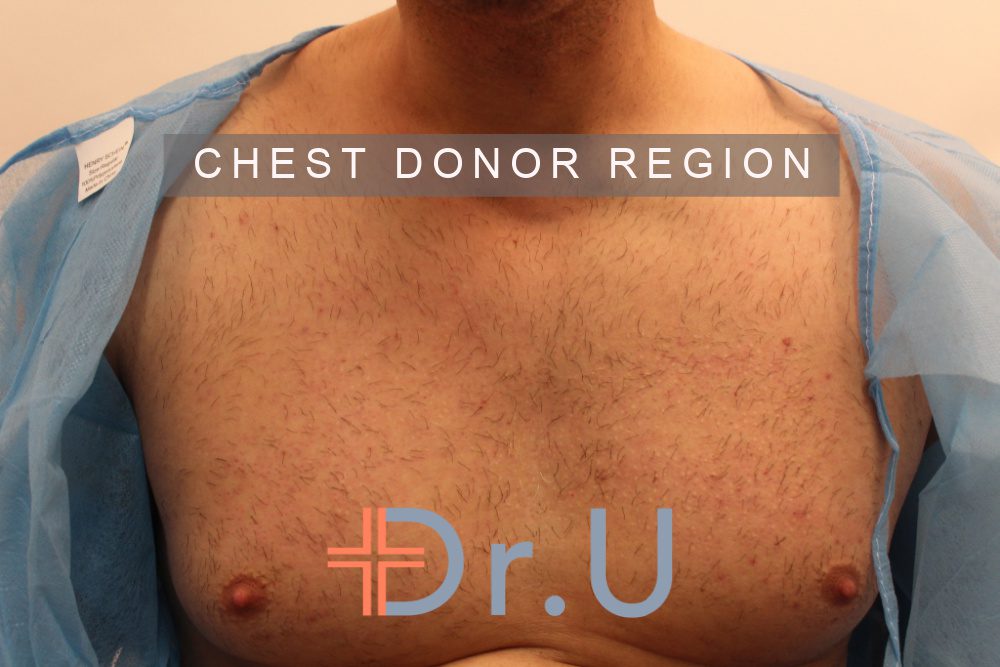 The chest was used to help supply additional donor grafts for patient's hair transplant procedure