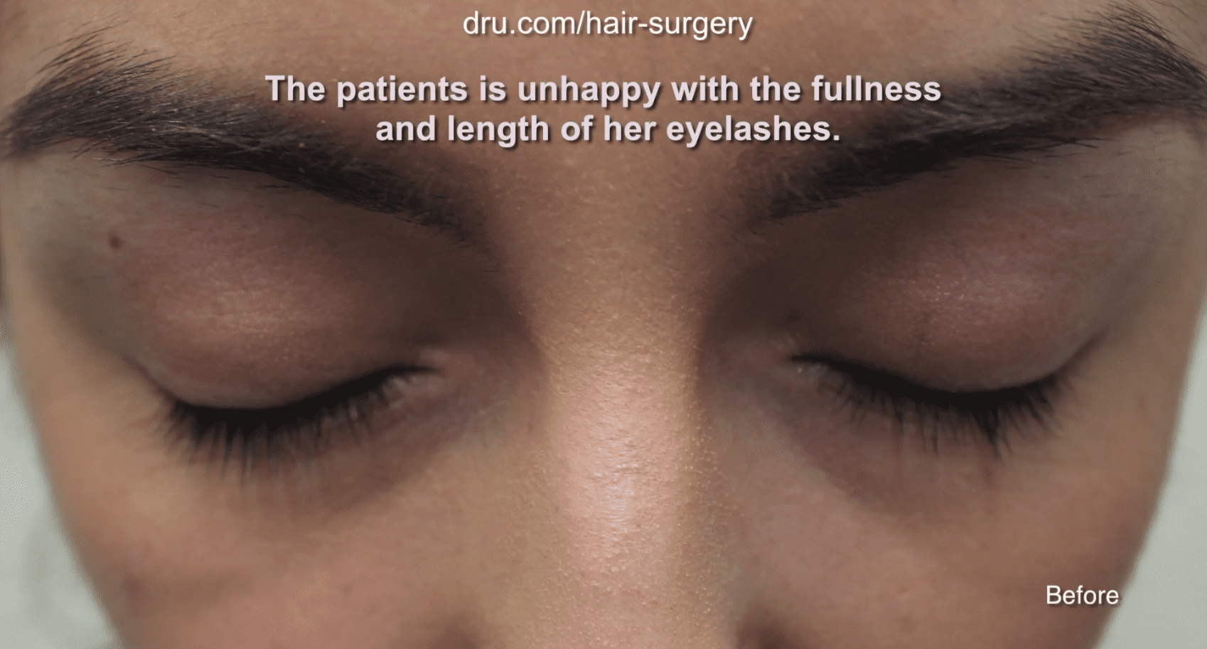 The patient was unsatisfied with the lack of density and length of her eyelashes before her eyelash hair transplantation with Dr. U.