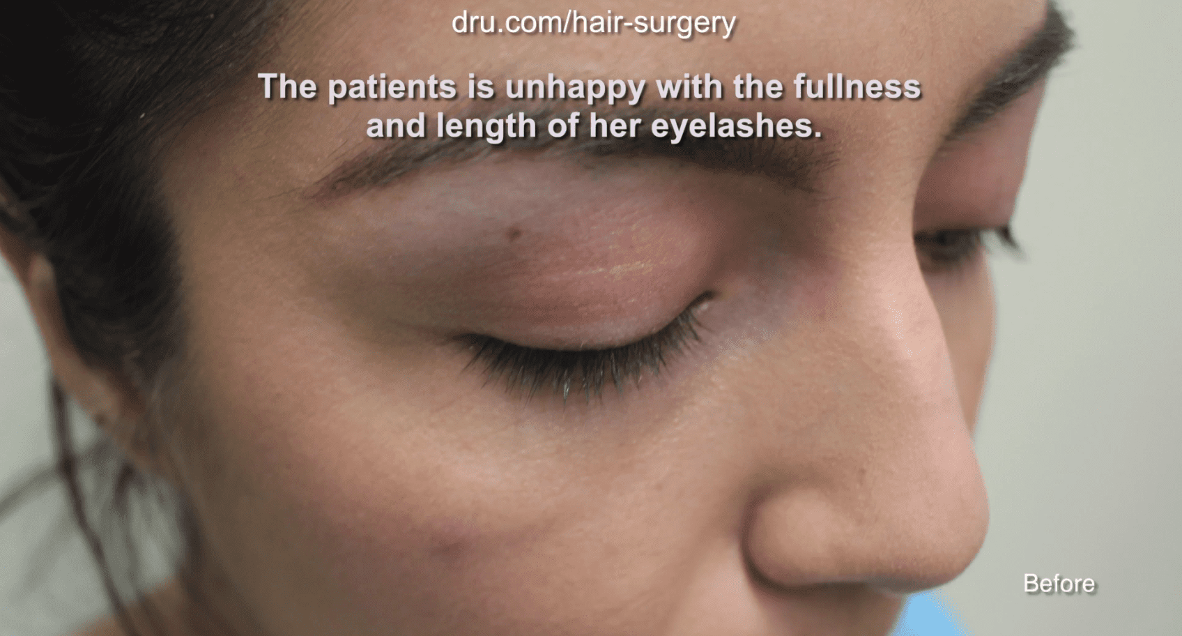 Instead of continuing to style her eyelashes every day to her desired density and length, the patient decided to consult Dr. U about an eyelash hair transplant.