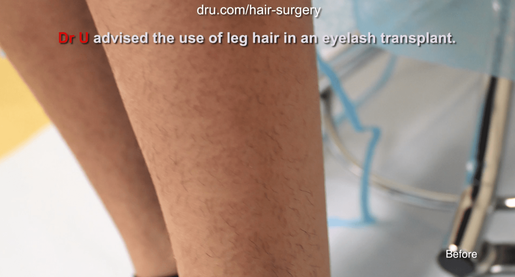 Dr. U used the patient's leg as the donor area for the eyelash surgery. While most hair clinics would struggle with the angled growth of body hair during the extraction process, Dr. U had the Dr. UGraft advantage and was able to safely and effectively harvest the grafts needed.