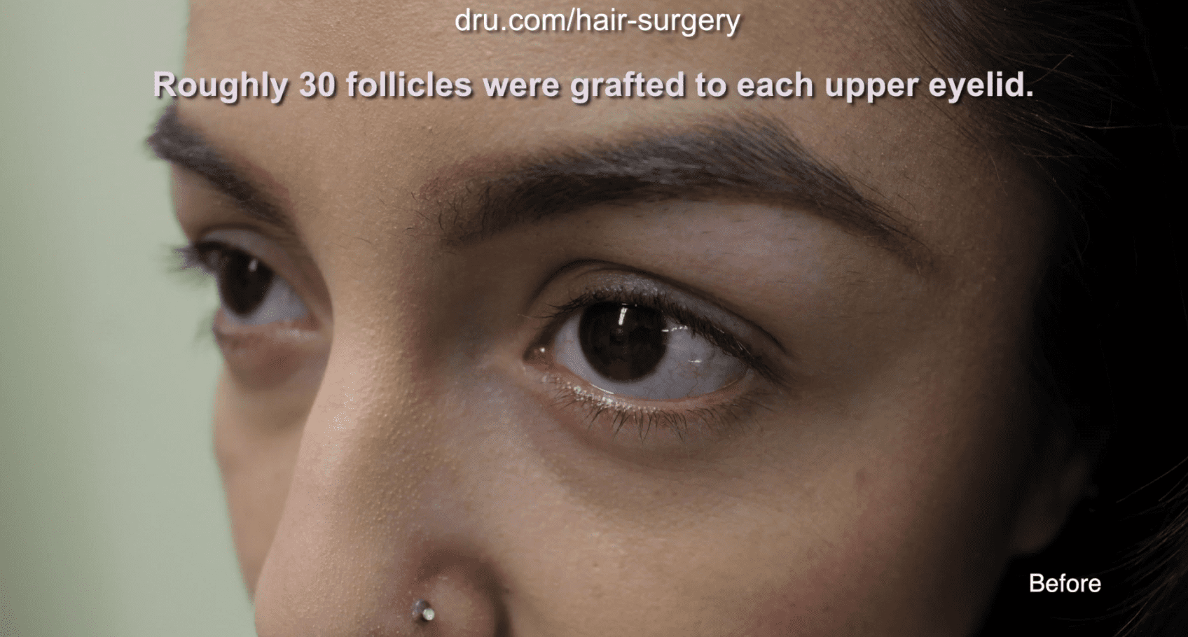 The Dr.UGraft allows for the use of any body hair, which gives the transplanted eyelashes their natural appeal.