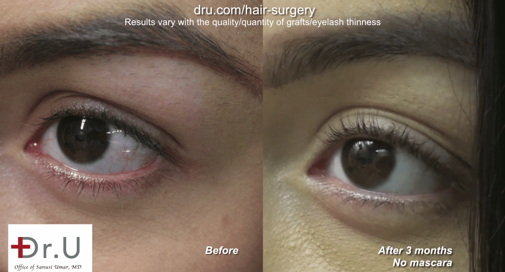 3 months post-operation, the patient noticed fuller and longer eyelashes.