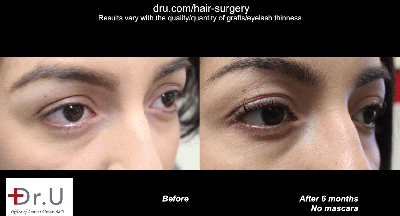 6 months after her surgery, the patient enjoys the fact that her permanent eyelashes require much less perming