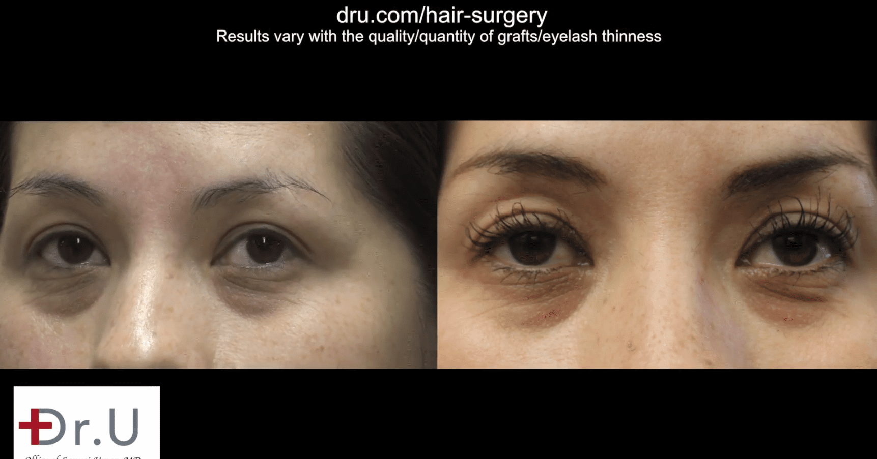 This patient got longer thicker eyelashes after Dr.UGraft eyelash extension surgery