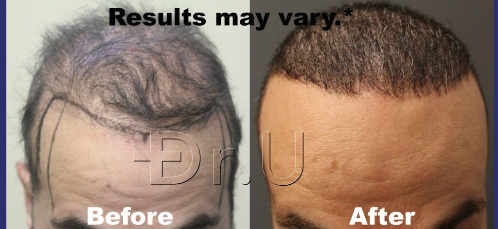 Facial and body hair is a proven solution for patients with insufficient donor hair. 