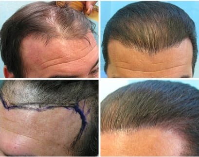 After flap surgery, before repair by Dr U, the patient had a scar on hairline and abnormally directed frontal hair as well as abnormal hairline temple recesses