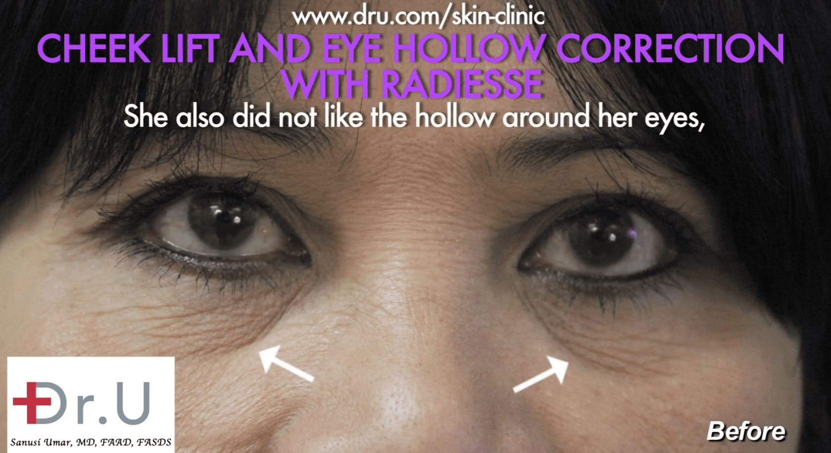 The patient was concerned about her hollow under eyes. 